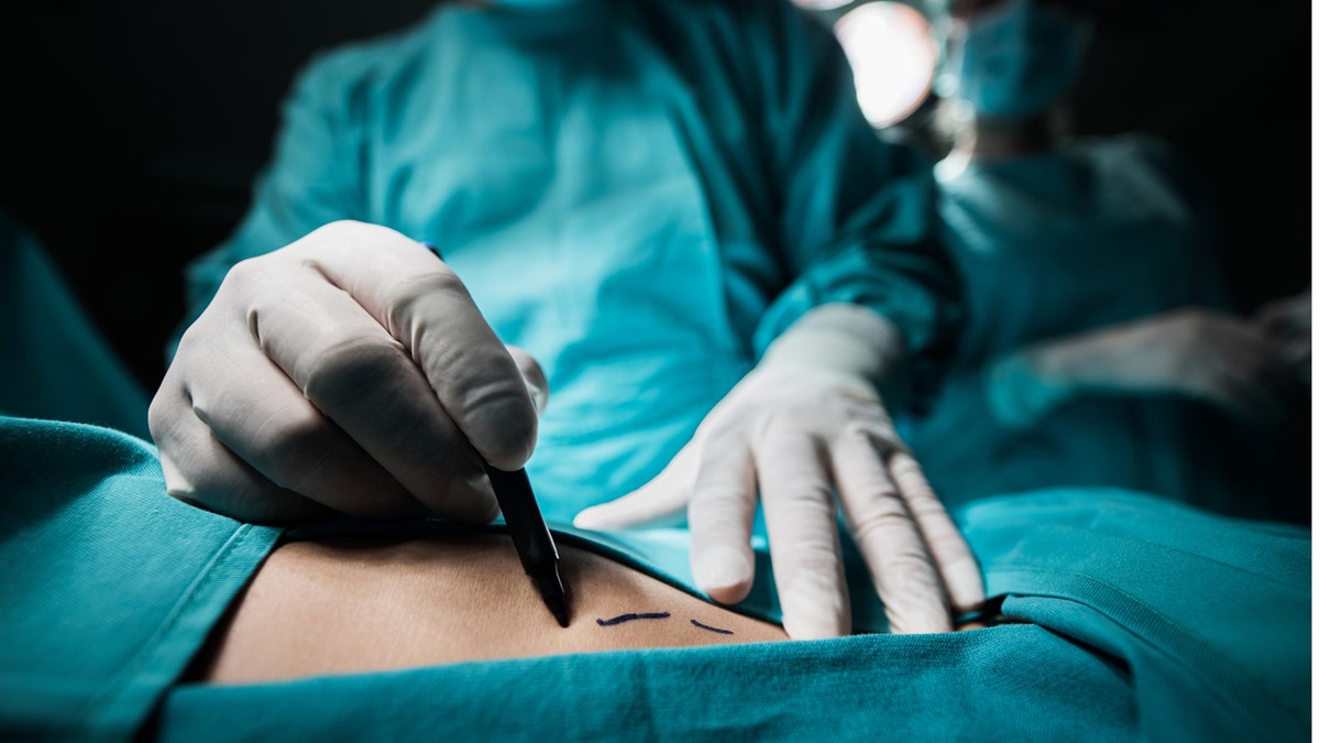 Close up of a plastic surgeon marking the human skin for surgery.