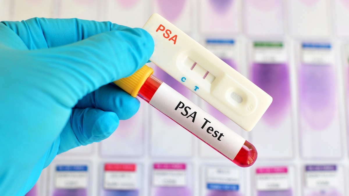 PSA testing (prostate cancer diagnosis) by using test cassette, the result showed positive (double red line)