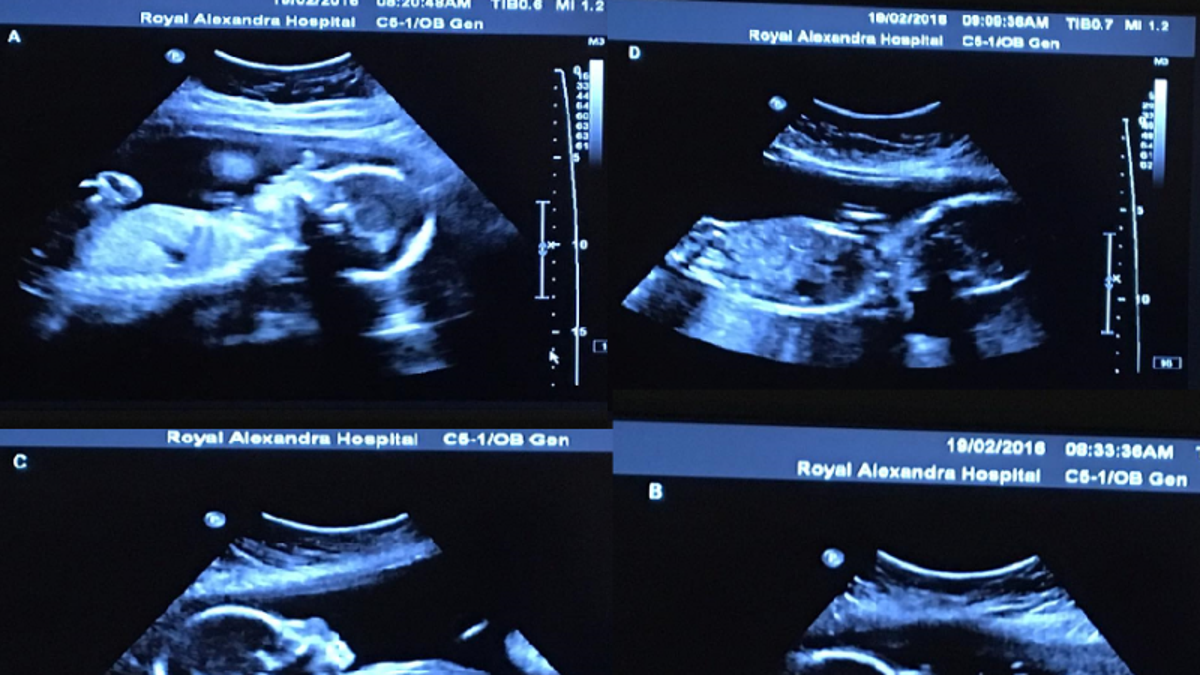 quadruplets canada ultrasound