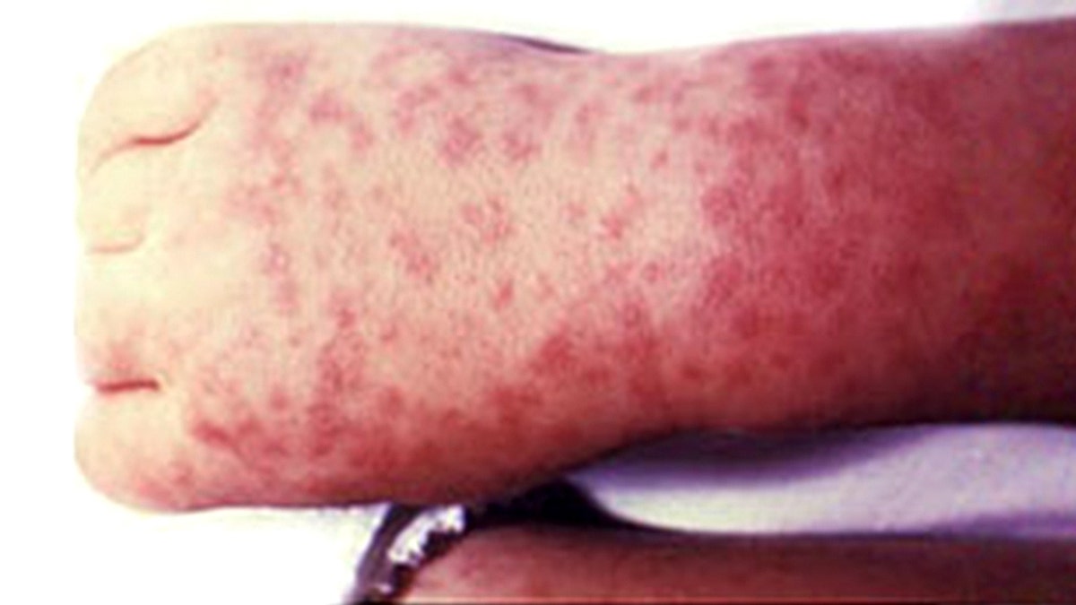 What is Rocky Mountain spotted fever? Signs, symptoms and treatment for