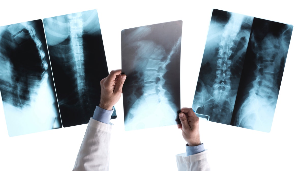 spinal cord x-ray scans istock large