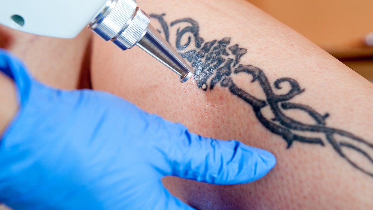 Best Tattoo Removal by Delco Times - InkAway Laser Tattoo Removal