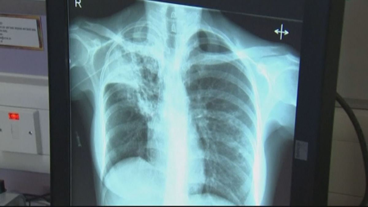 tuberculosis_xray