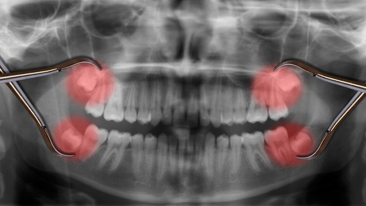 wisdom teeth removal istock