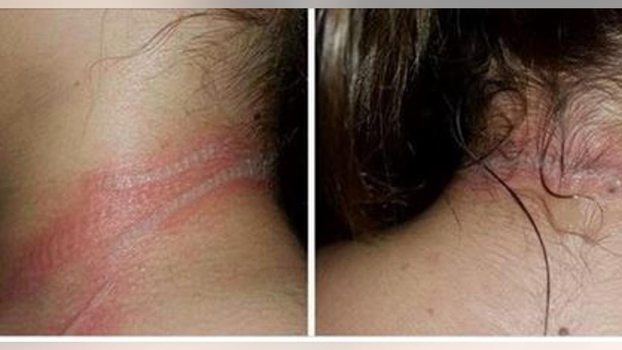 Freak accident with cellphone leaves teen with second-degree burns on neck 