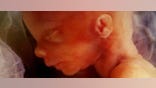 fetus in womb. Photo: Getty Images