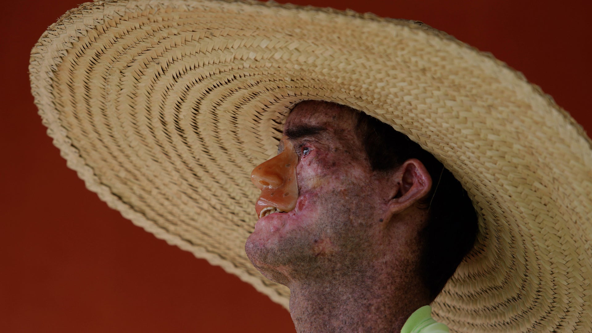 Rare_Disease_Brazil__4_