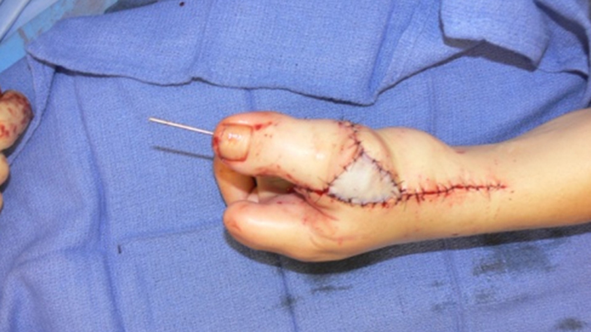 Toe implanted following surgery
