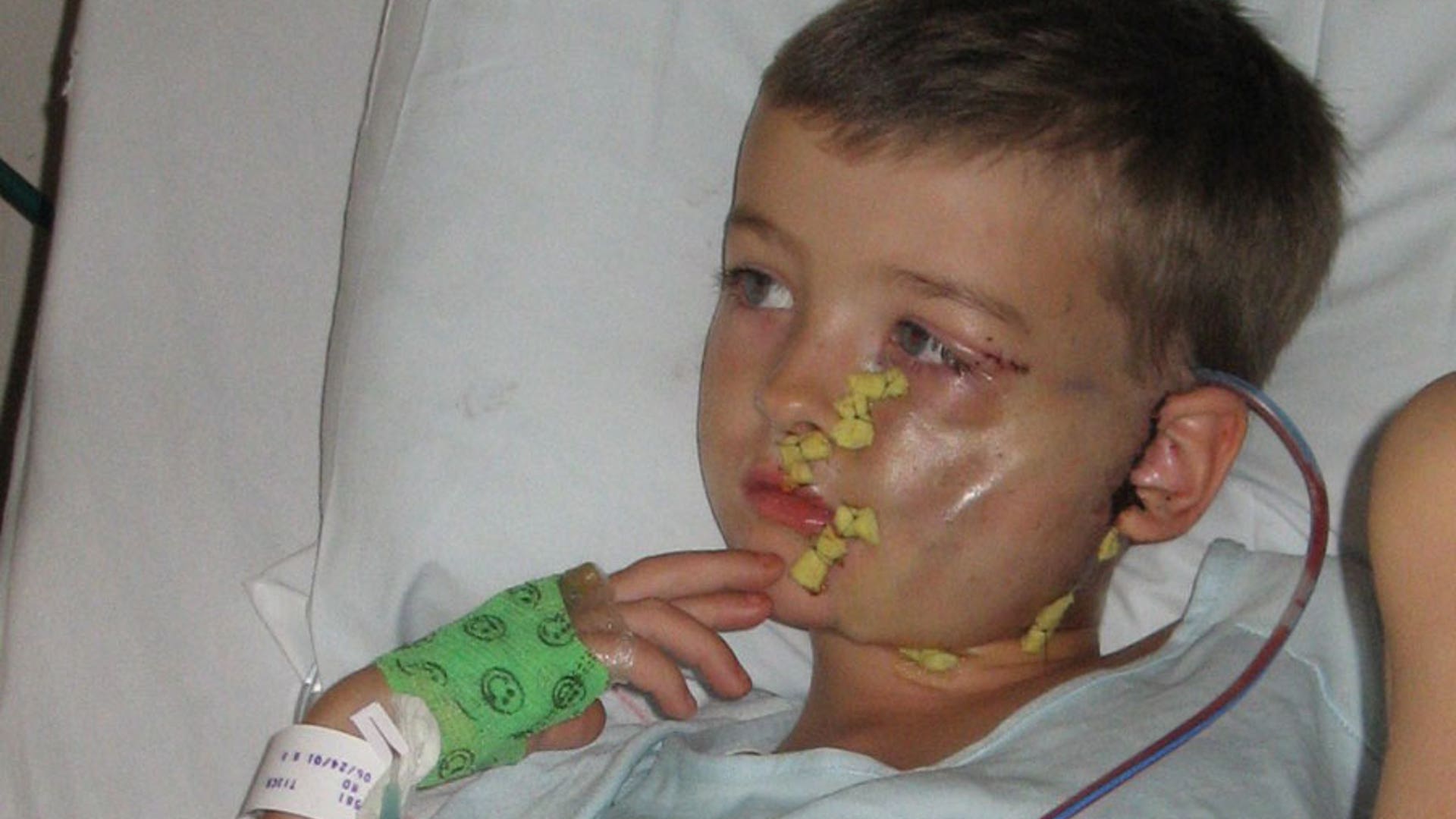 Hank after his first surgery