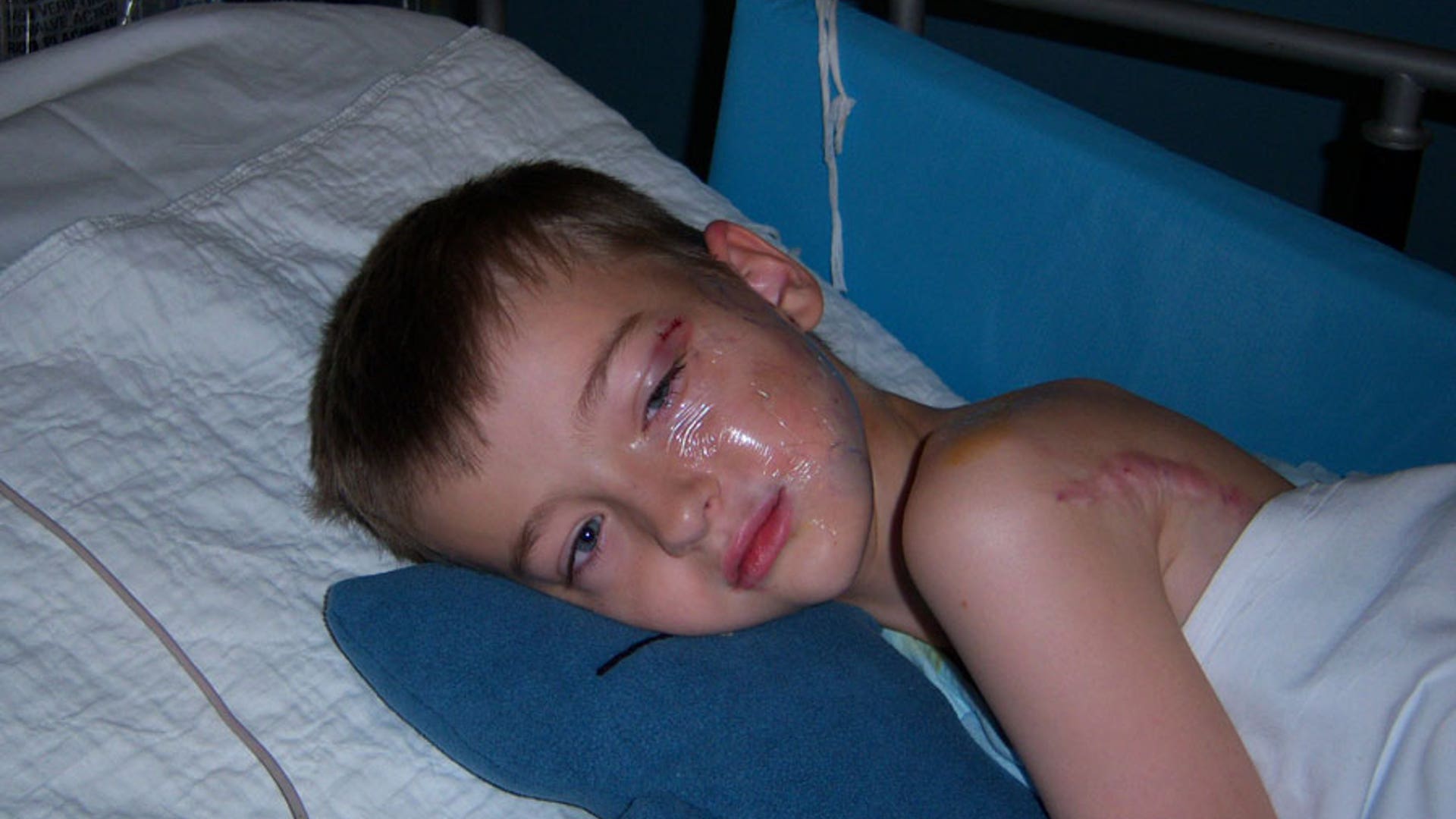 Hank after his second surgery