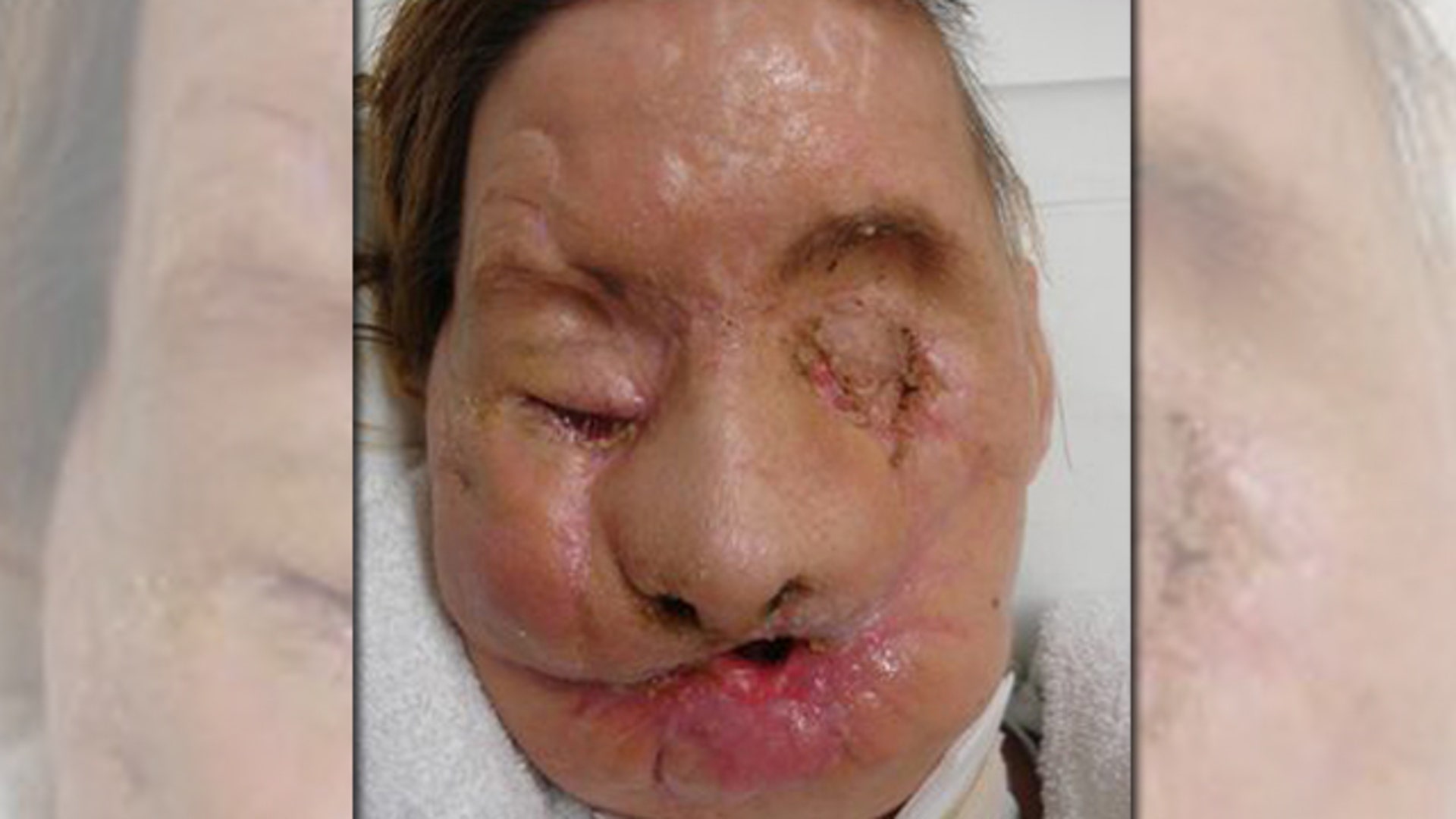 Charla Nash After Chimp Attack