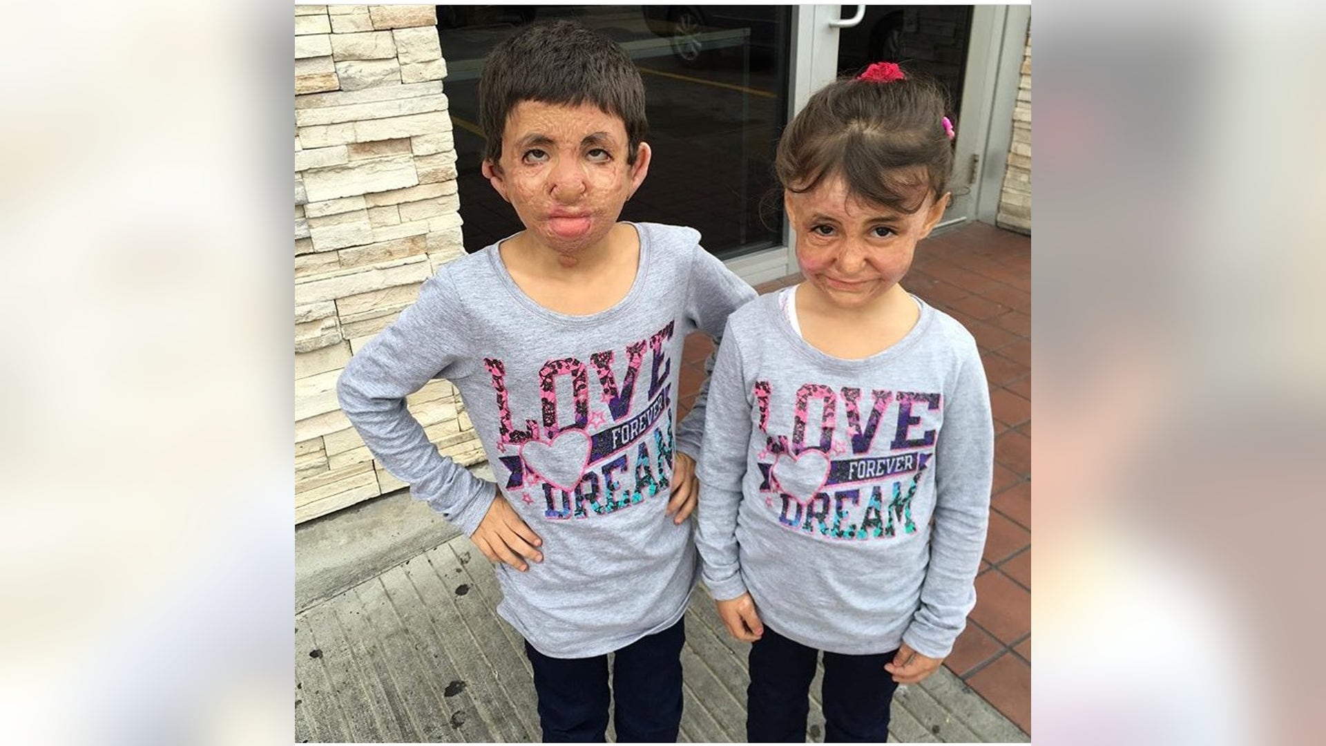 Fatima and Reema, victims of the Syrian War, are being treated at Shriner's Hospital in Texas.