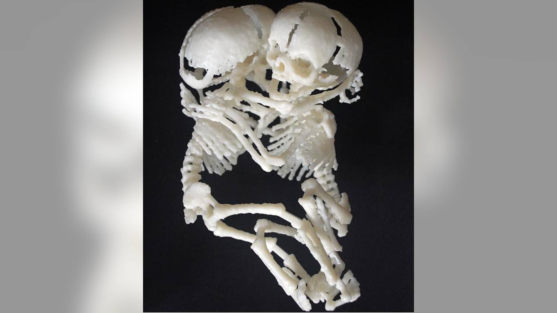 Hugging Conjoined Twins