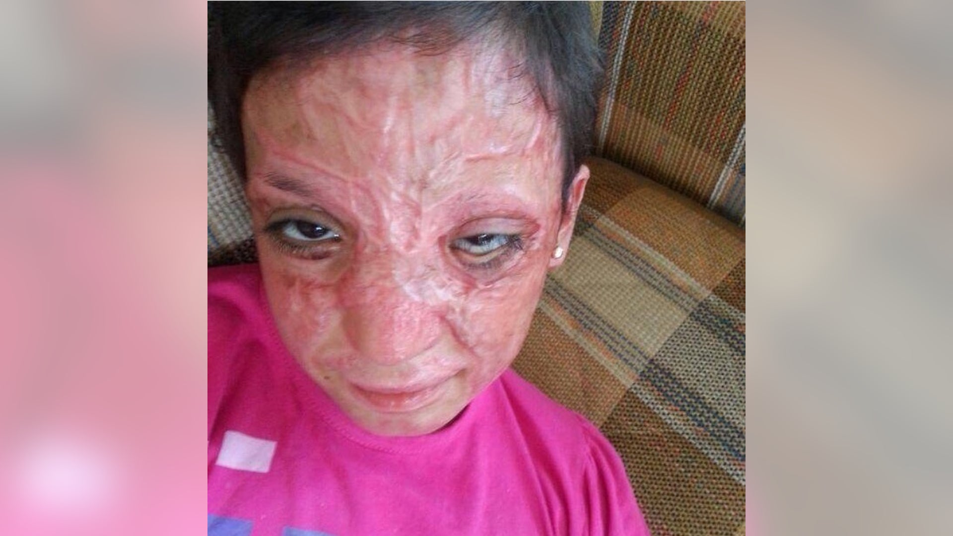 Israa before she was treated at Shriner's. 