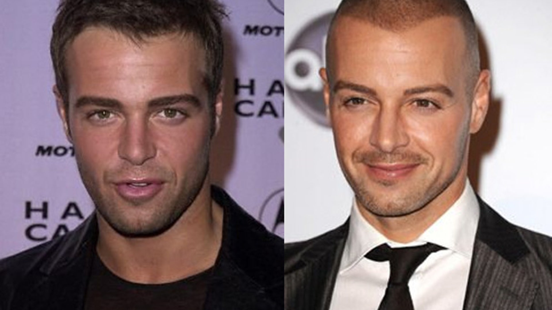 Joey_Lawrence_Hairloss