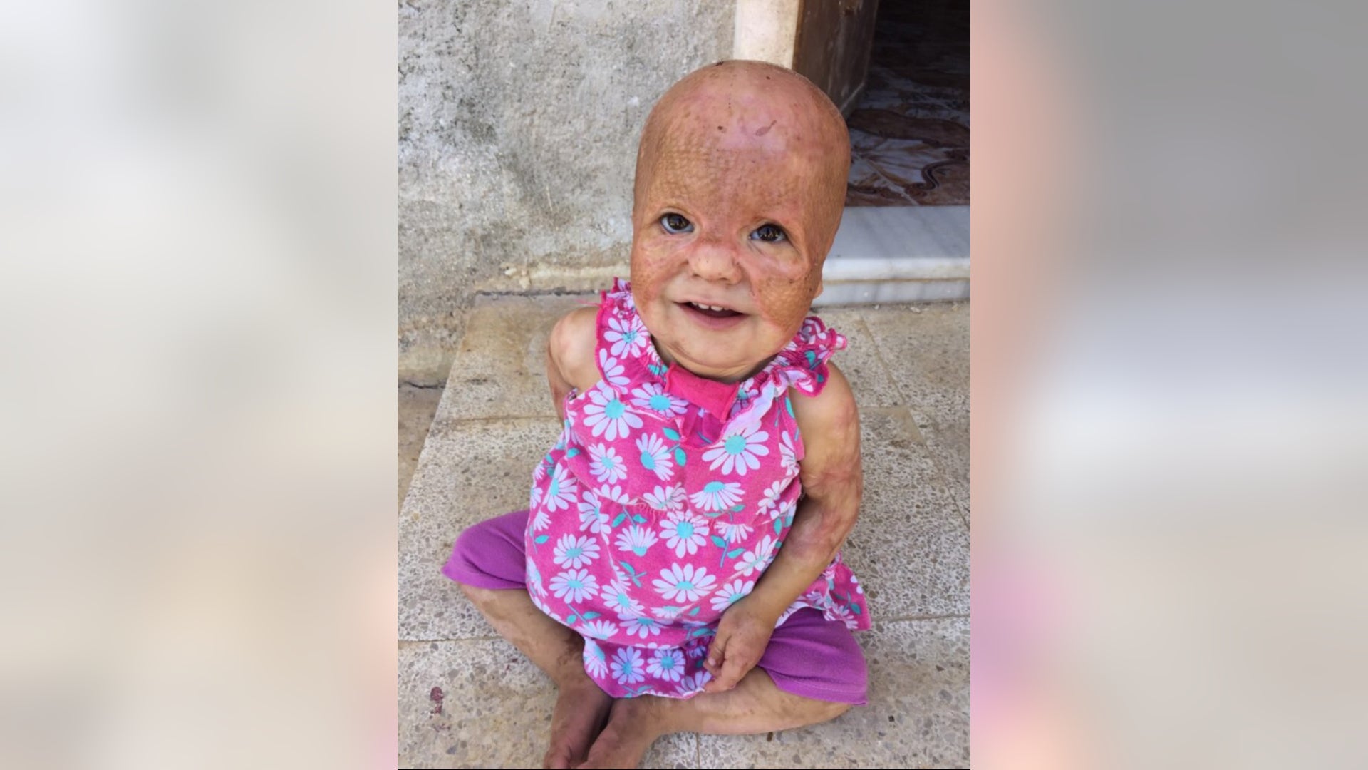 Kawthar, 2, from Idlib, was successfully treated at Shriner’s and returned to join family in Turkey. 