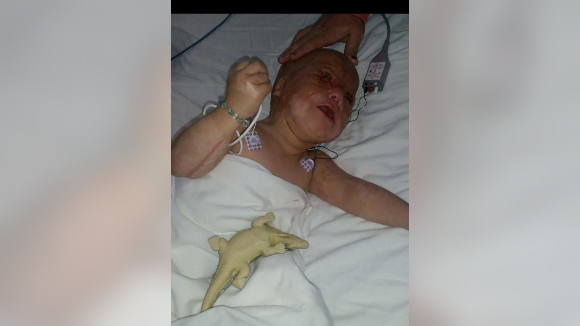 Kawthar, now 2, during treatment. She was horribly burned and disfigured from a bomb that killed several of her siblings.