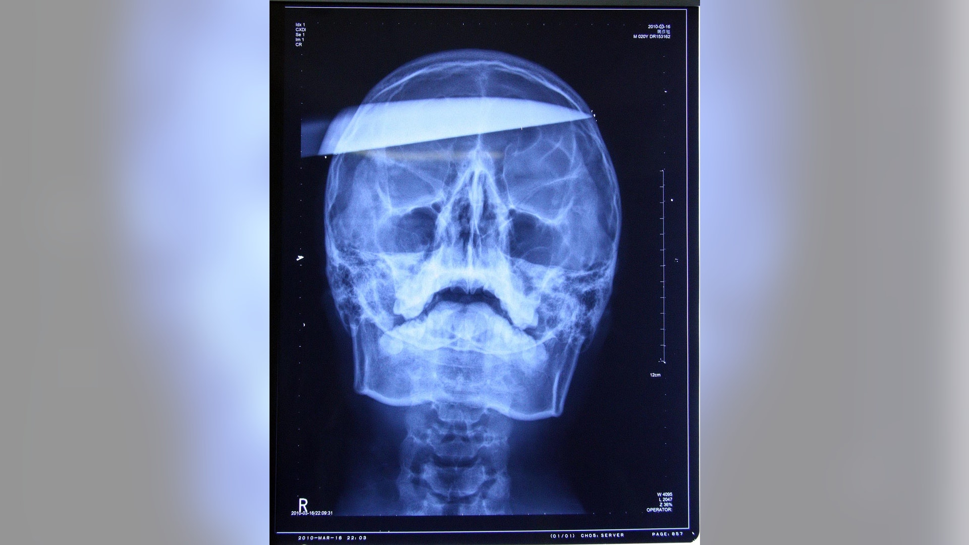 Knife in Teen's Head