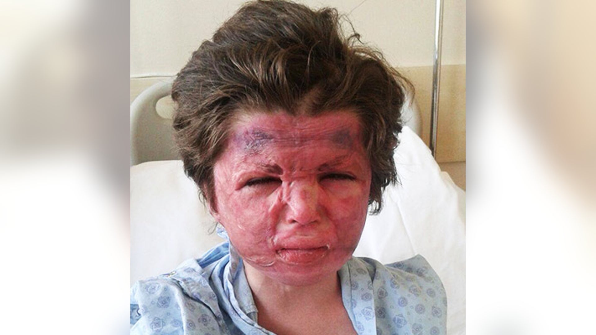 Meyyas is waiting to undergo treatment at Shriner's in Texas. 