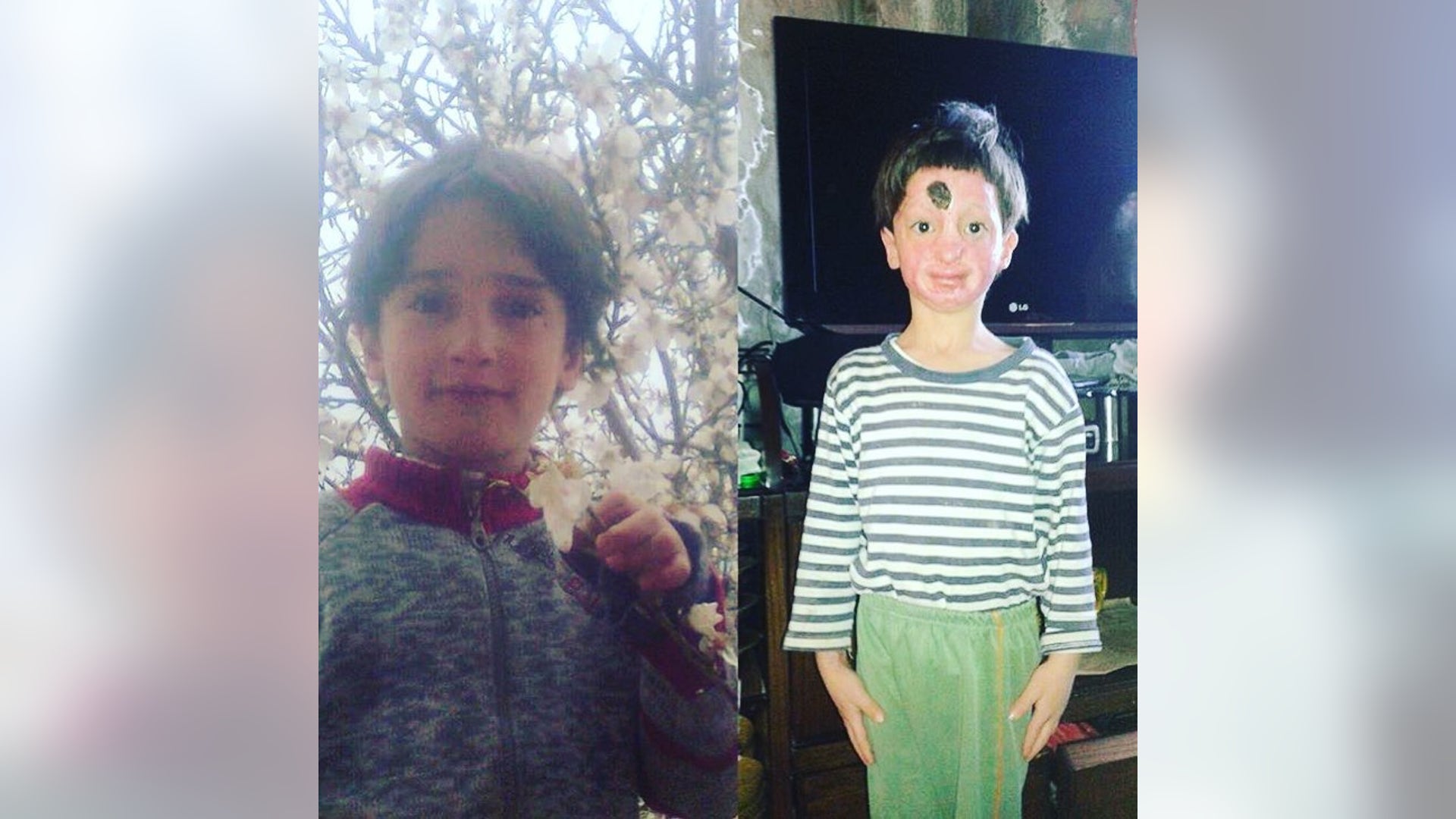 Moath, 7, whose face was deeply seared by flames in Aleppo, recently arrived his begin his long road to recovery.