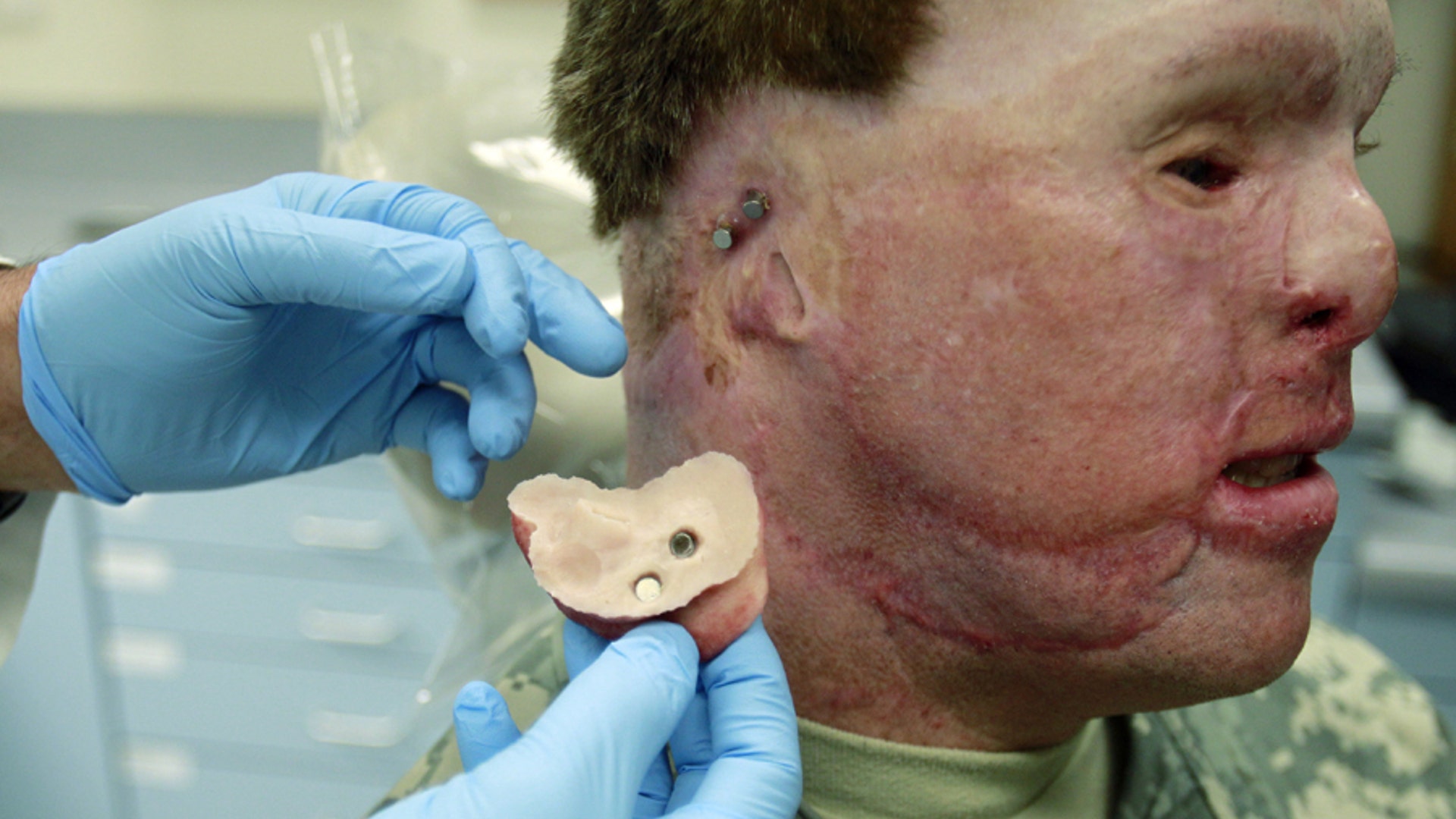 Prosthetic ear