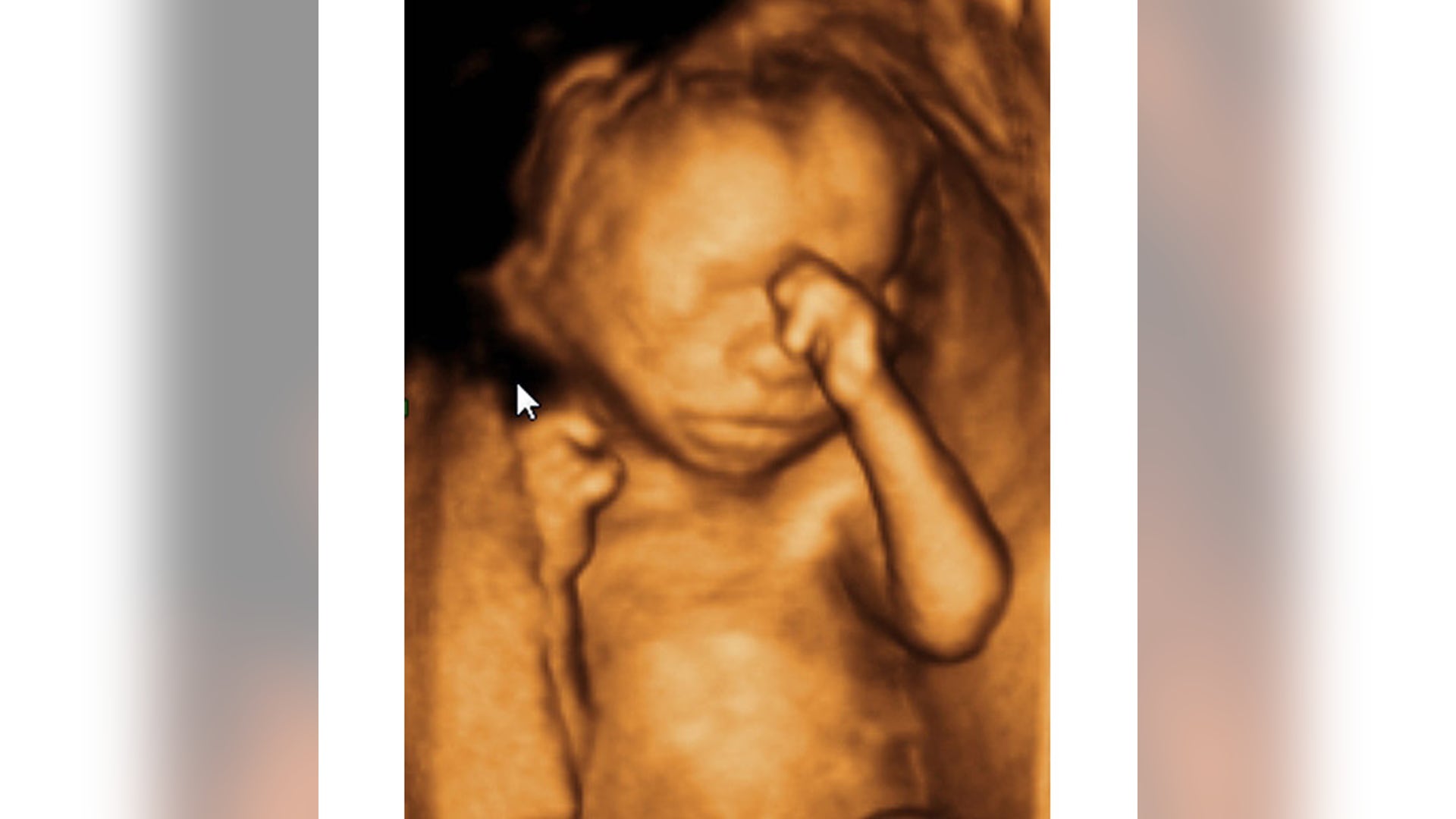 Ultrasound Image