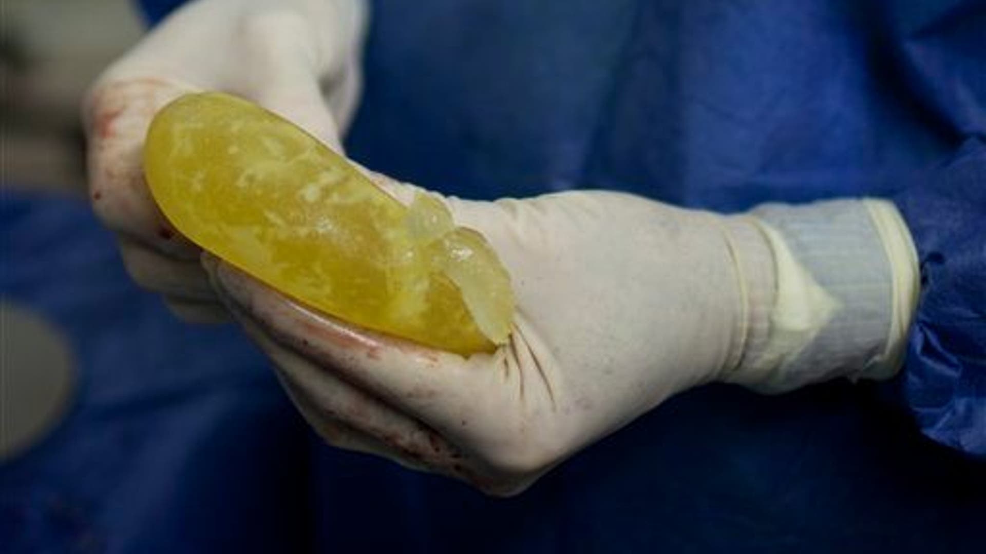 Venezuela_Breast_Implants_2