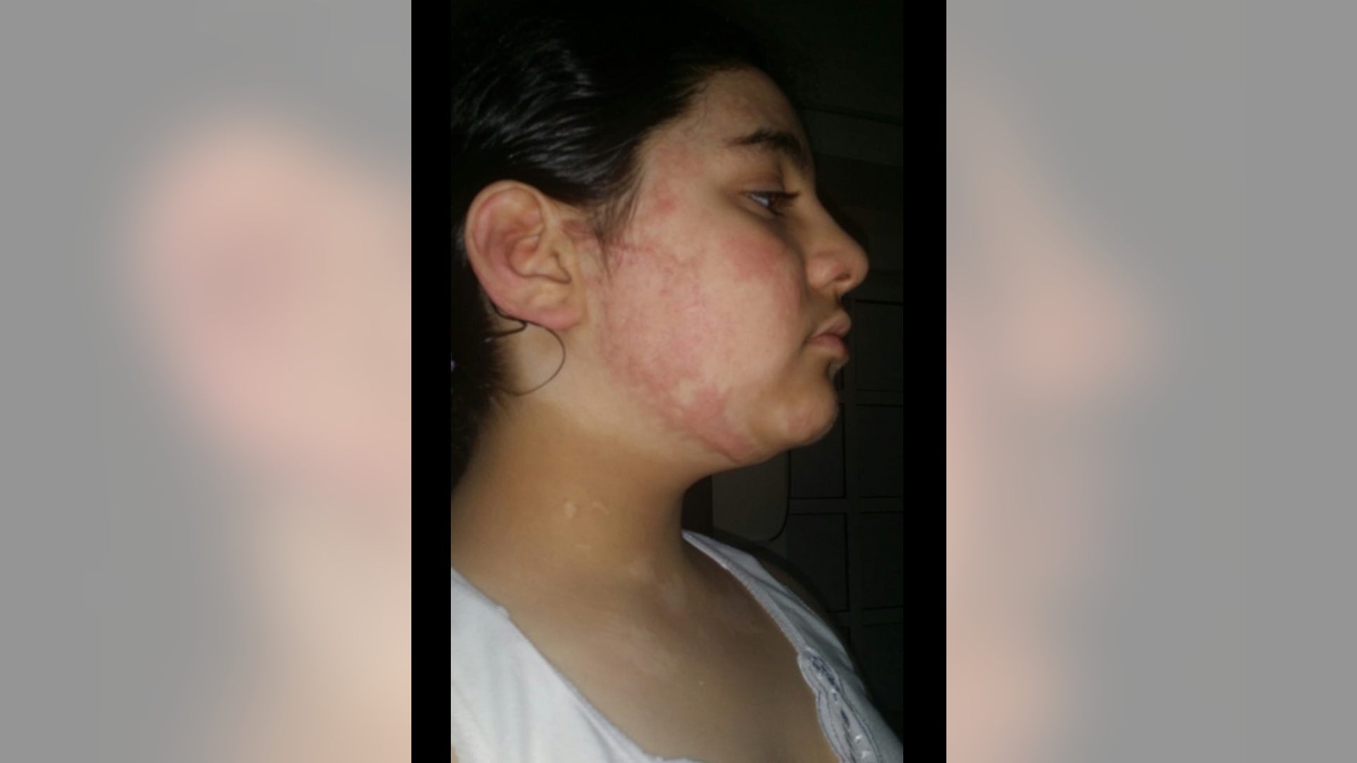 A jet missile in Daraa killed the family of 10-year-old Yumna and also left her with melted flesh. 