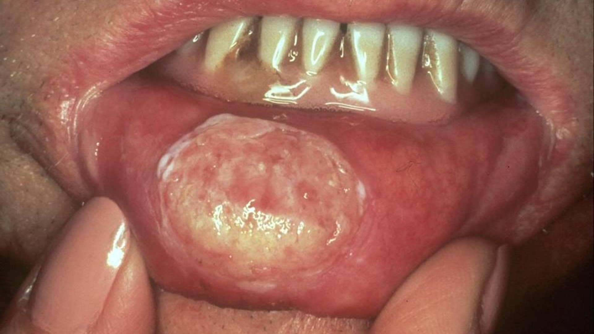 The devastating effects of smokeless tobacco use