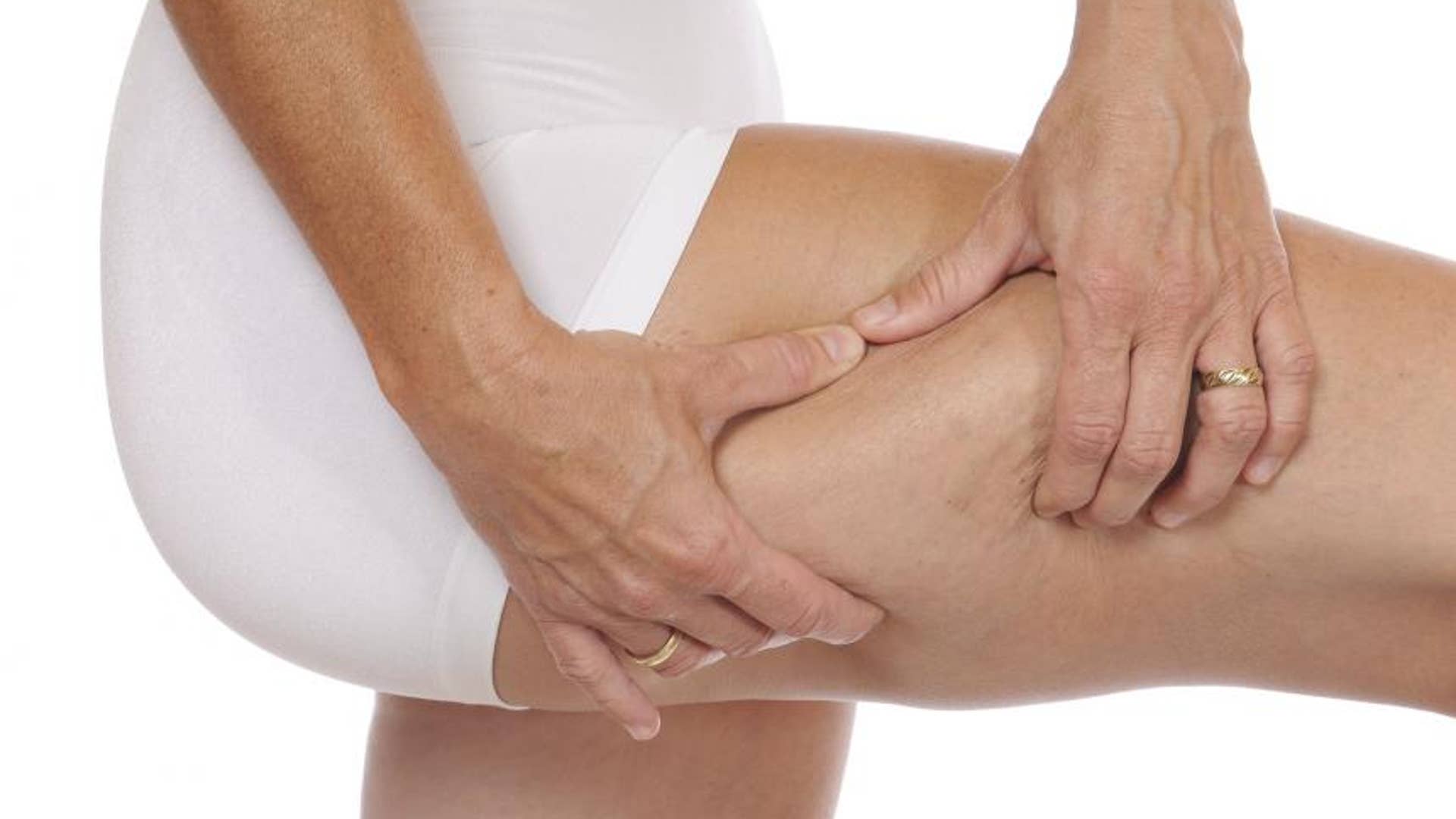 Myth 2: You can get rid of cellulite.