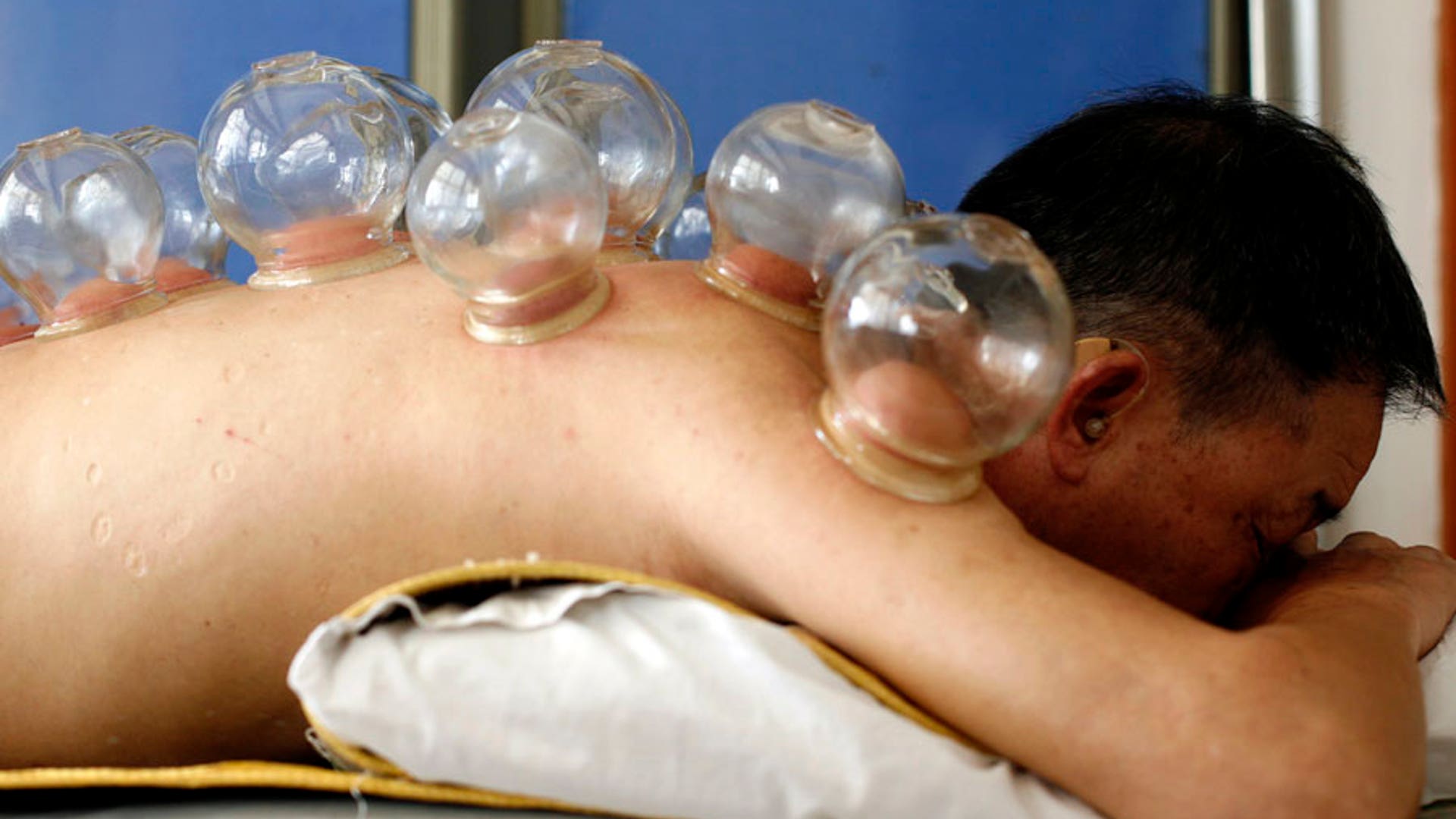 Cupping 