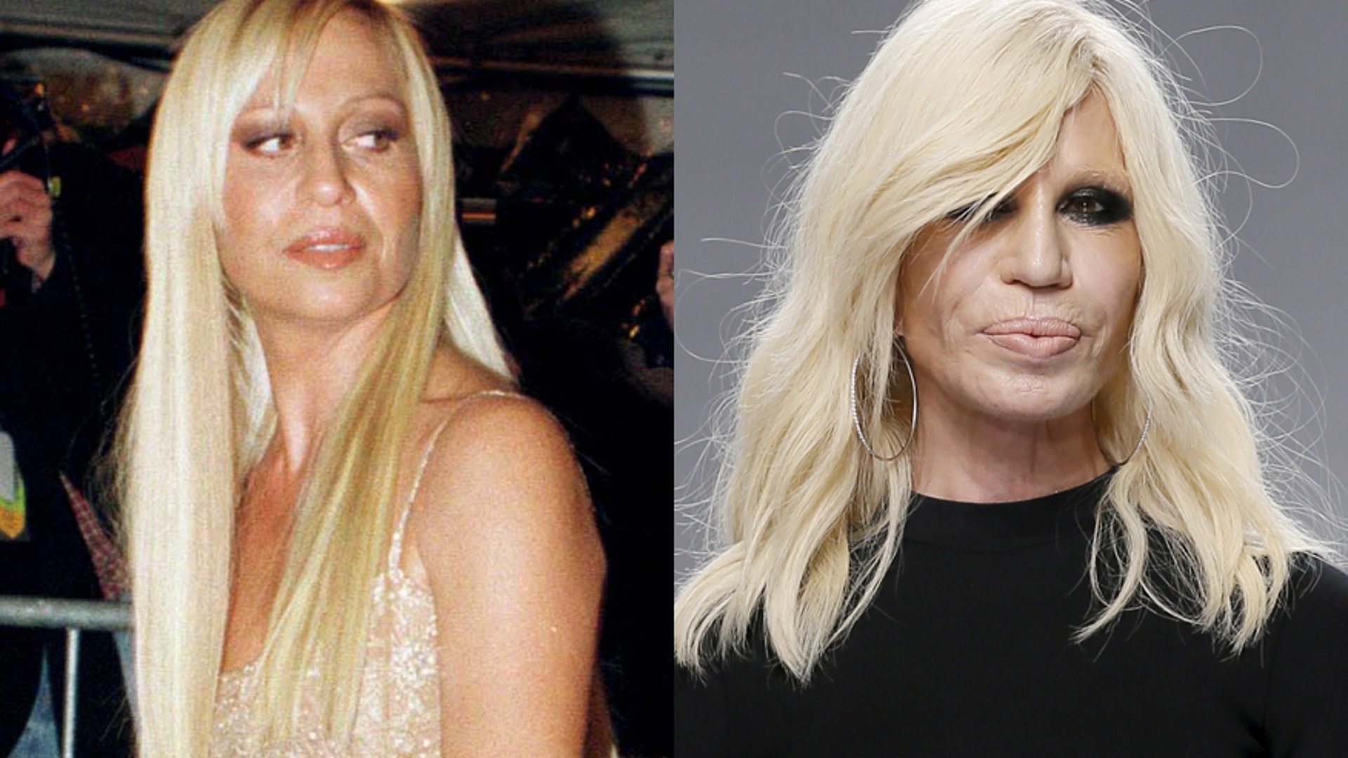Celebrity plastic surgery disasters | Fox News