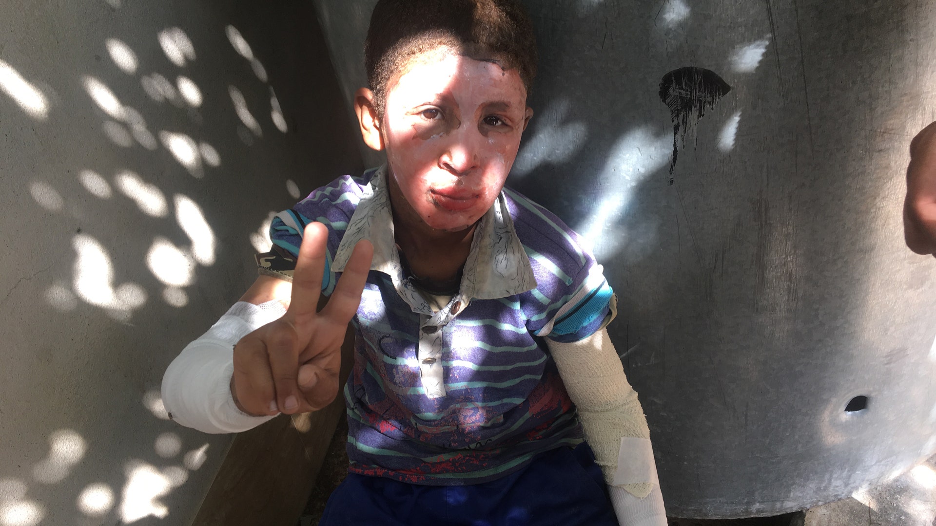 A young boy with a burned face shows the peace sign, May 5, 2017