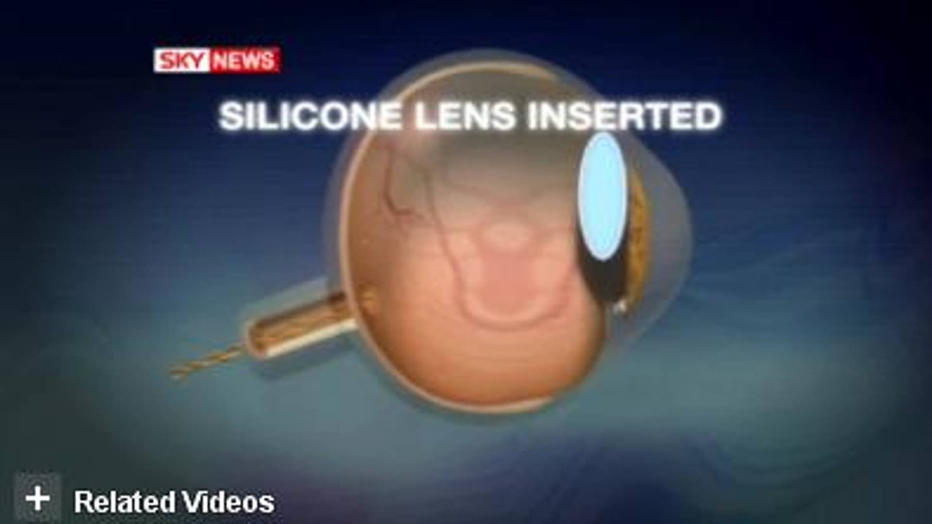 High-Definition Eyeballs