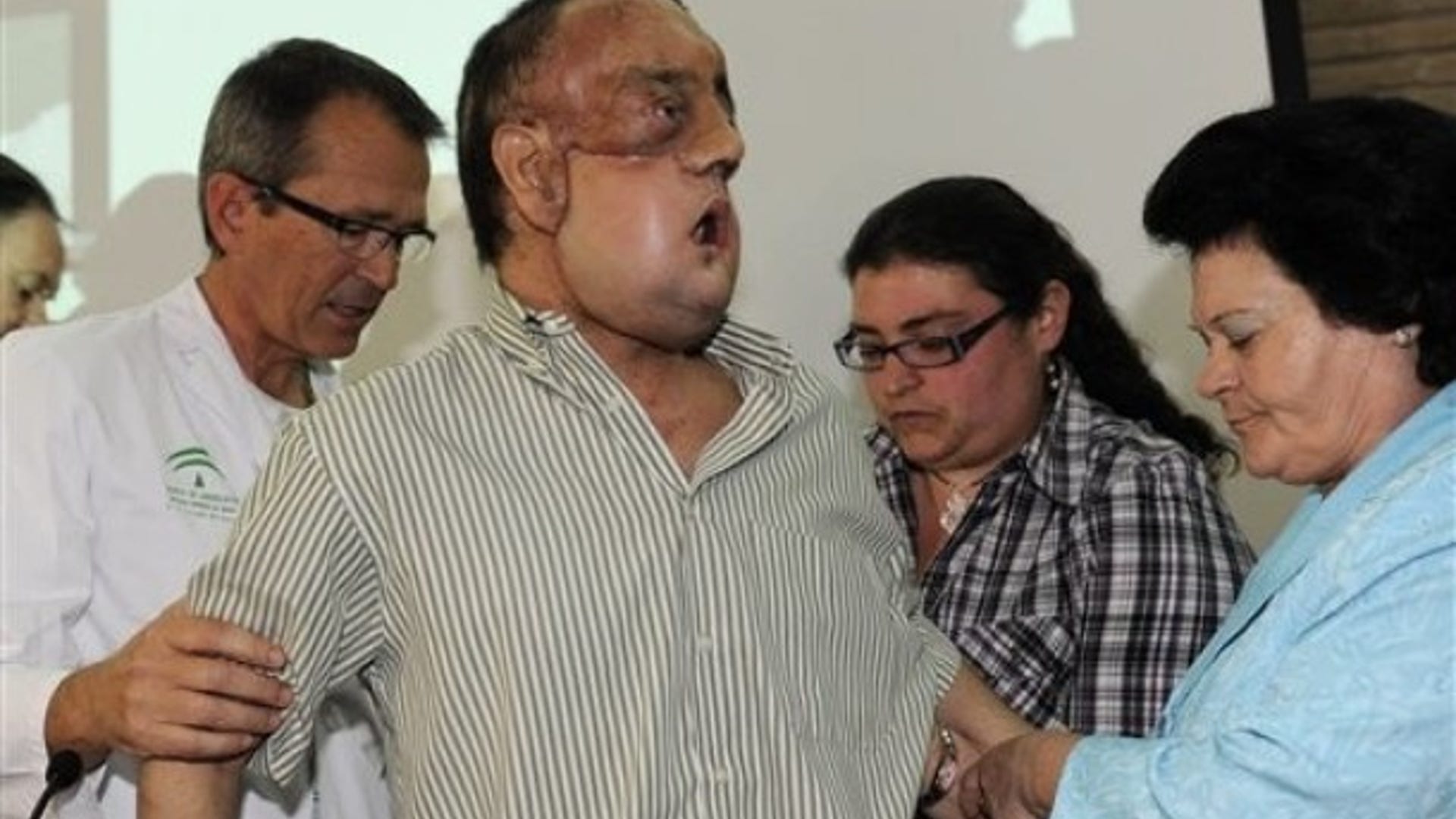 Partial Face Transplant