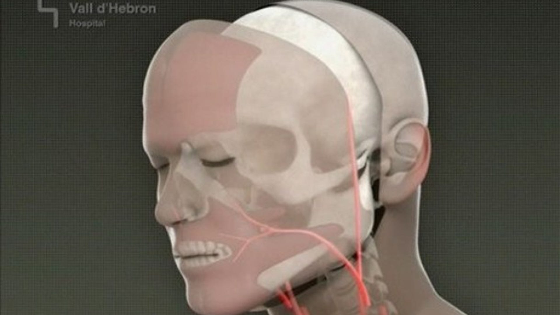 11th Face Transplant Worldwide