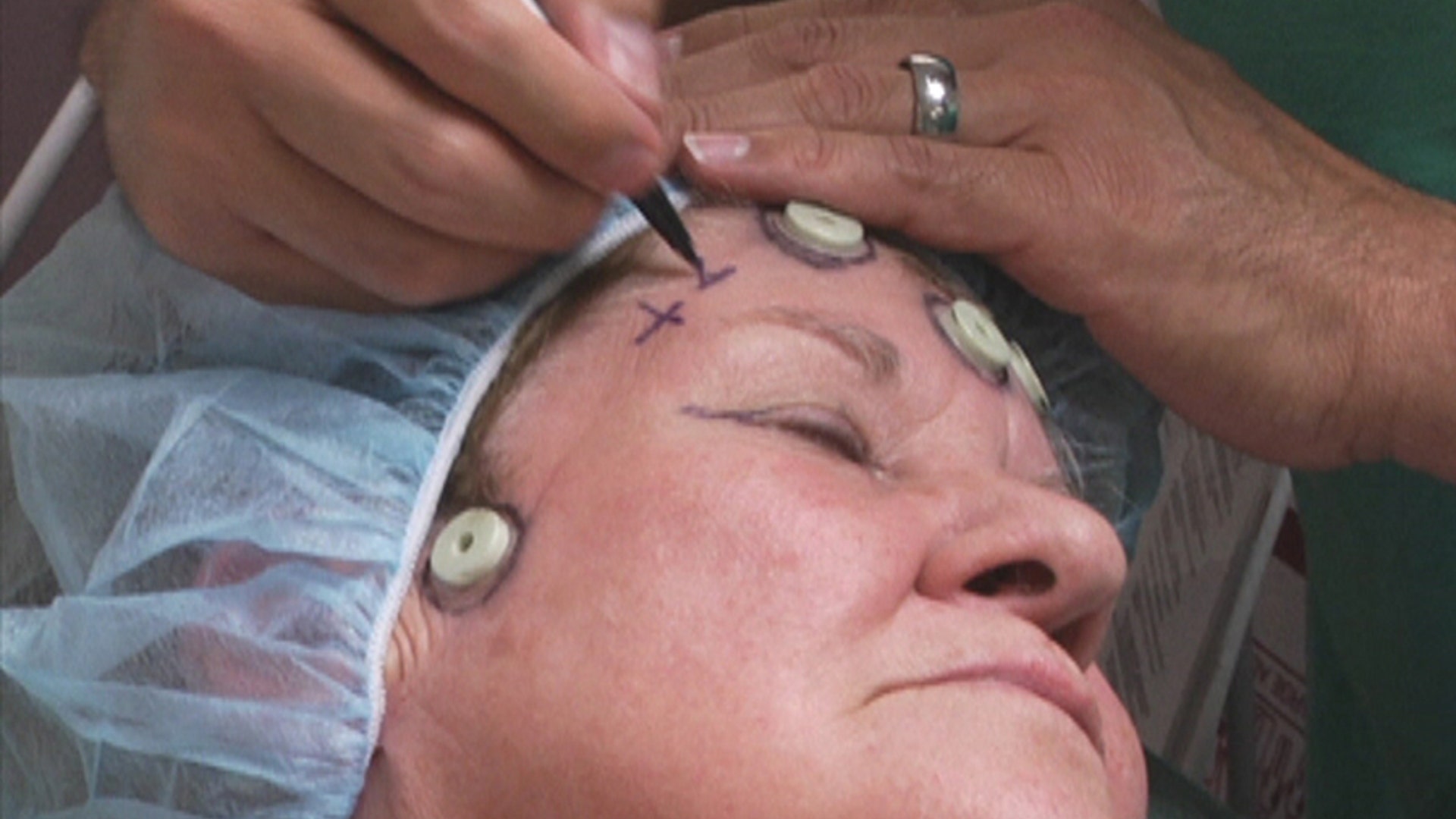Marking the Eyelid Before Surgery