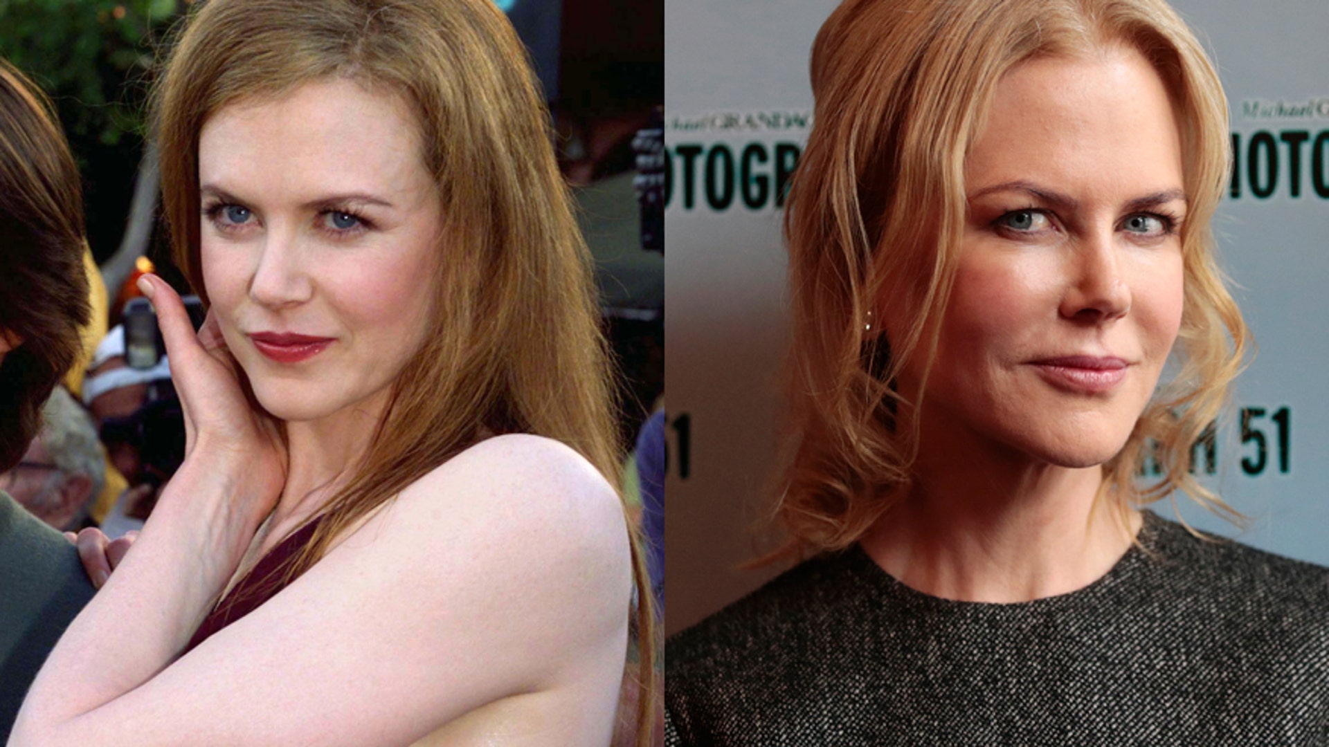 Nicole Kidman S Plastic Surgery Transformation Top Do vrogue.co