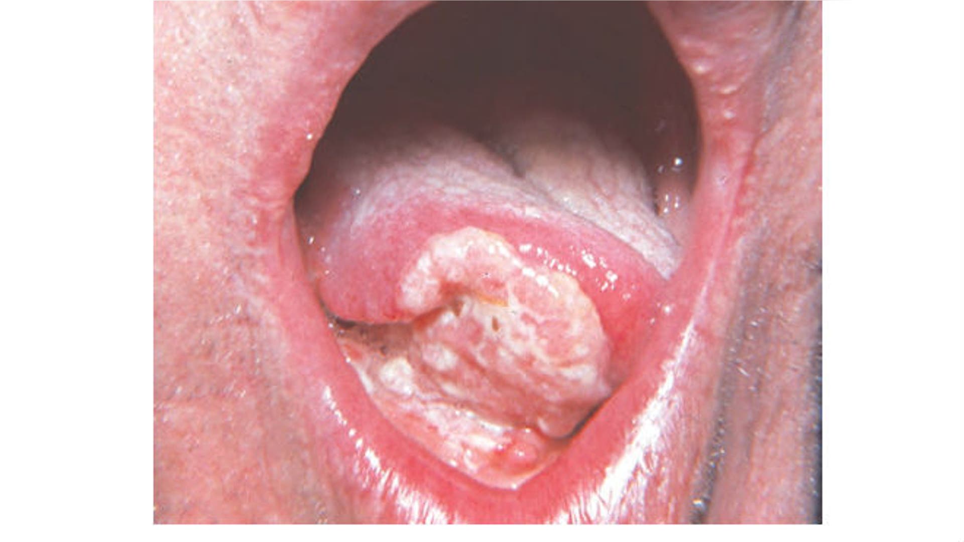 The devastating effects of smokeless tobacco use