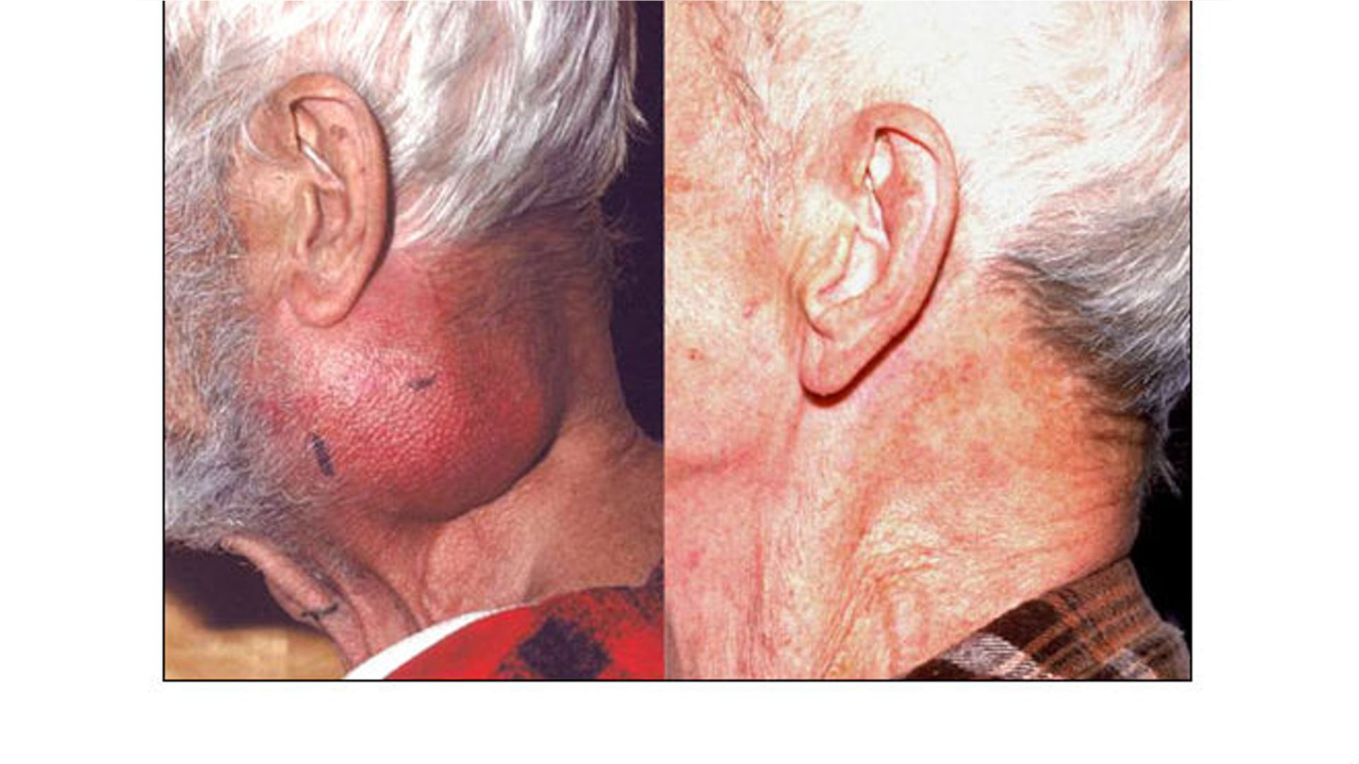 The devastating effects of smokeless tobacco use