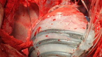 By squeezing and twisting, new robot could keep hearts pumping