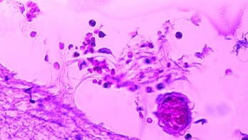 Officials seek students who partied with Oregon man stricken by meningococcal disease