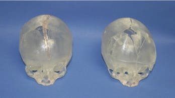 Surgeons reconstruct baby’s skull with 3D printing technology