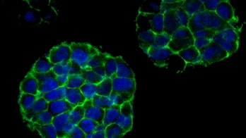 3D tumors are printed in the lab