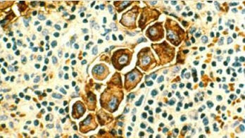 US cancer survival rates improving, study finds