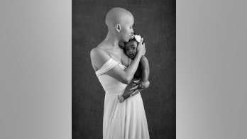 Mom diagnosed with alopecia celebrates health with mother-daughter photoshoot