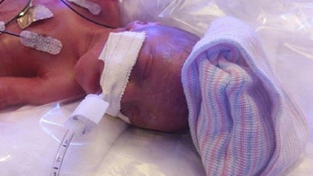 In rare birth, identical twins born 18 days apart after live-saving surgery