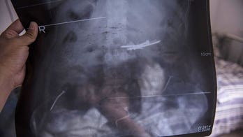 Doctors remove 8 nails from stomach of woman with mental illness