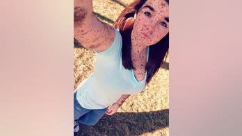 19-year-old born with body covered in birthmarks is ‘proud to be different’