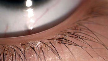 Child has eyelashes removed after doctors find 20 lice